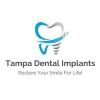 Tampa Dental Implants